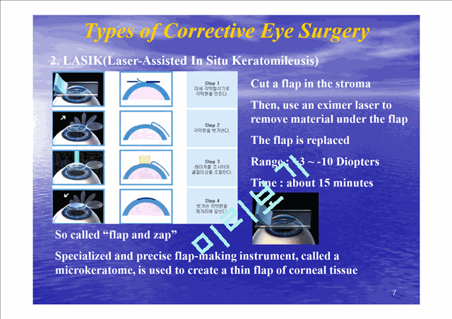 Refrative Laser Eye Surgery   (7 )
